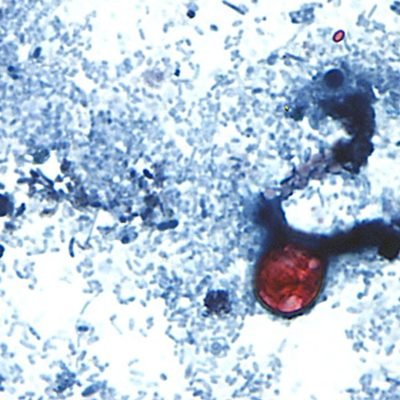 Two die as cases of ‘explosive diarrhoea’ infection surge in US state